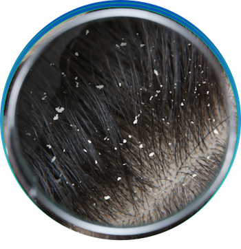 កំចាត់អង្គែរចេញពីស្បែកក្បាលបានយ៉ាងឆាប់រហ័ស